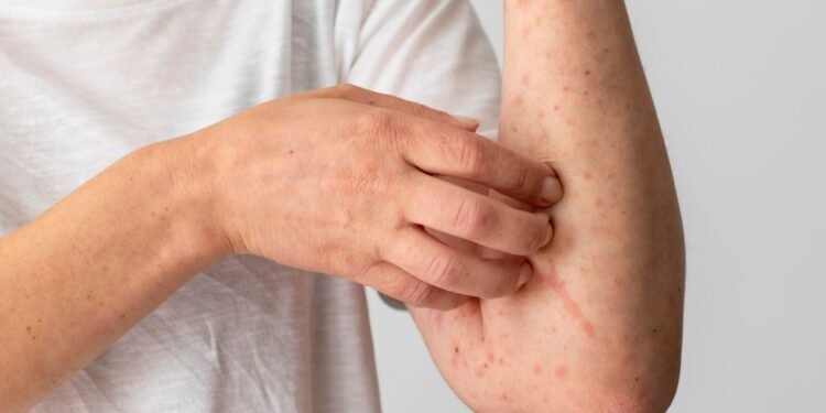 Salud confirma primera muerte por sarampión en México en 2026; brote suma 987 casos