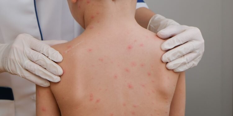 En dos meses, México supera los casos de sarampión de todo el año pasado