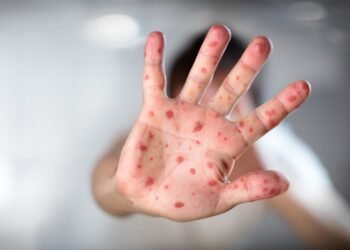 Viruela símica avanza en Yucatán; se coloca como segundo lugar en el país