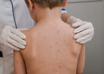 ¿Tus hijos ya están vacunados? Continúa campaña contra el sarampión en México