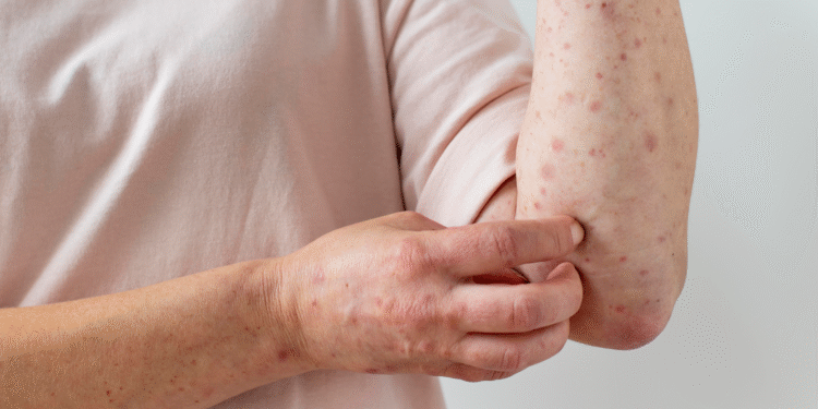 ¿Cómo identificar la MPOX? autoridades piden aislamiento para cortar contagios